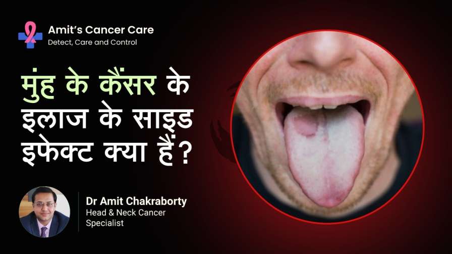 Side Effects of Oral Cancer Treatment
