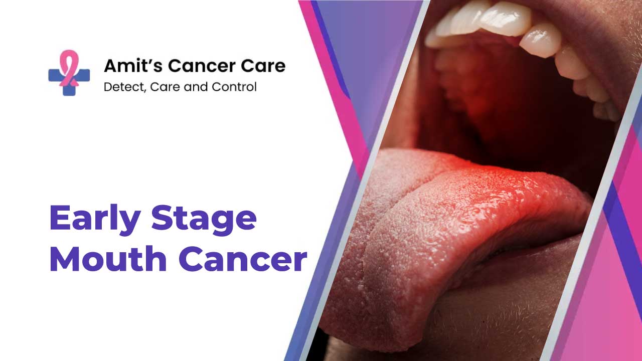Early stage mouth cancer<br />
