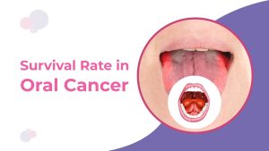 Survival Rate in Oral Cancer
