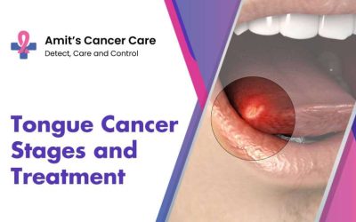 Tongue Cancer Stages and Treatment
