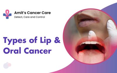 Most Common Types of Lip and Oral (Mouth) Cancer